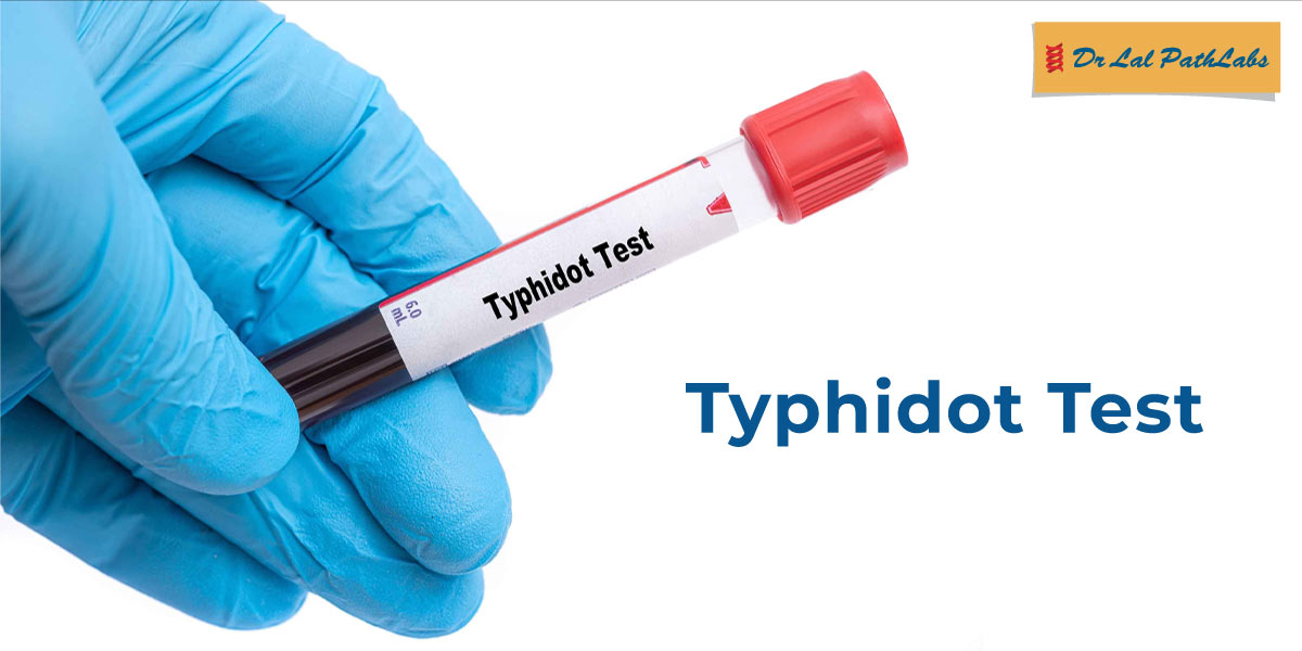 The Typhidot Test detects antibodies against Salmonella Typhi, helping diagnose typhoid fever quickly and precisely. Read the blog to know more https bit The Typhidot Test detects antibodies against Salmonella Typhi, helping diagnose typhoid fever quickly and precisely