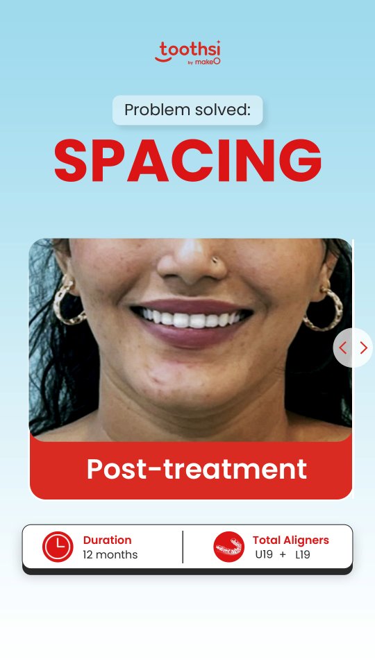 Naziya always felt self conscious about the gaps in her teeth and her deep bite