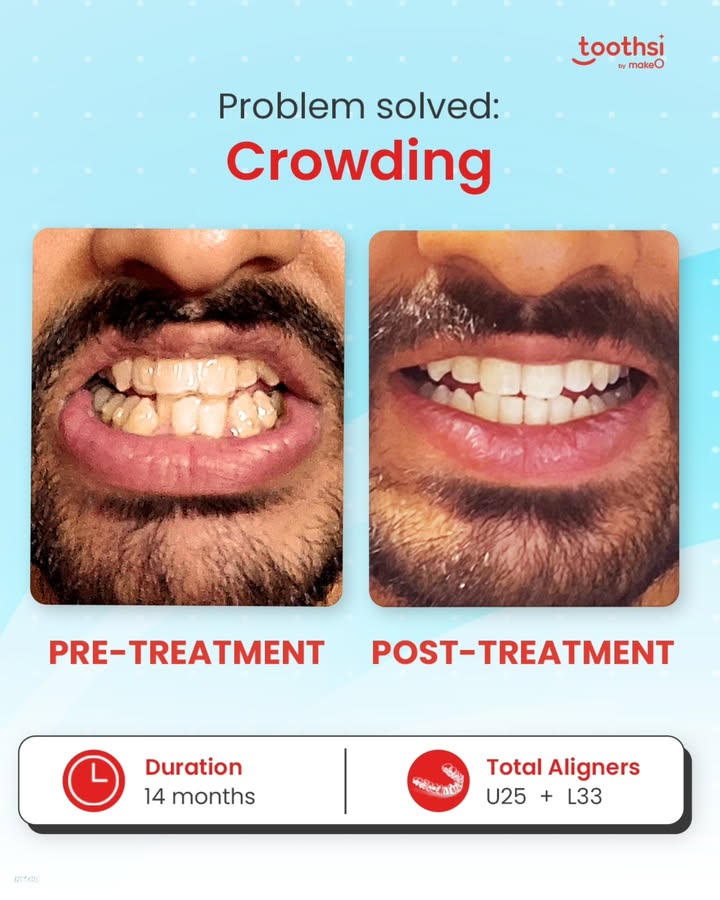 Shiva always felt self conscious about his crowded teeth. Smiling in pictures or speaking in public made him uneasy. But once he started his journey with toothsi invisible aligners, everything changed Shiva always felt self conscious about his crowded teeth. Smiling in pictures or speaking in public made him uneasy