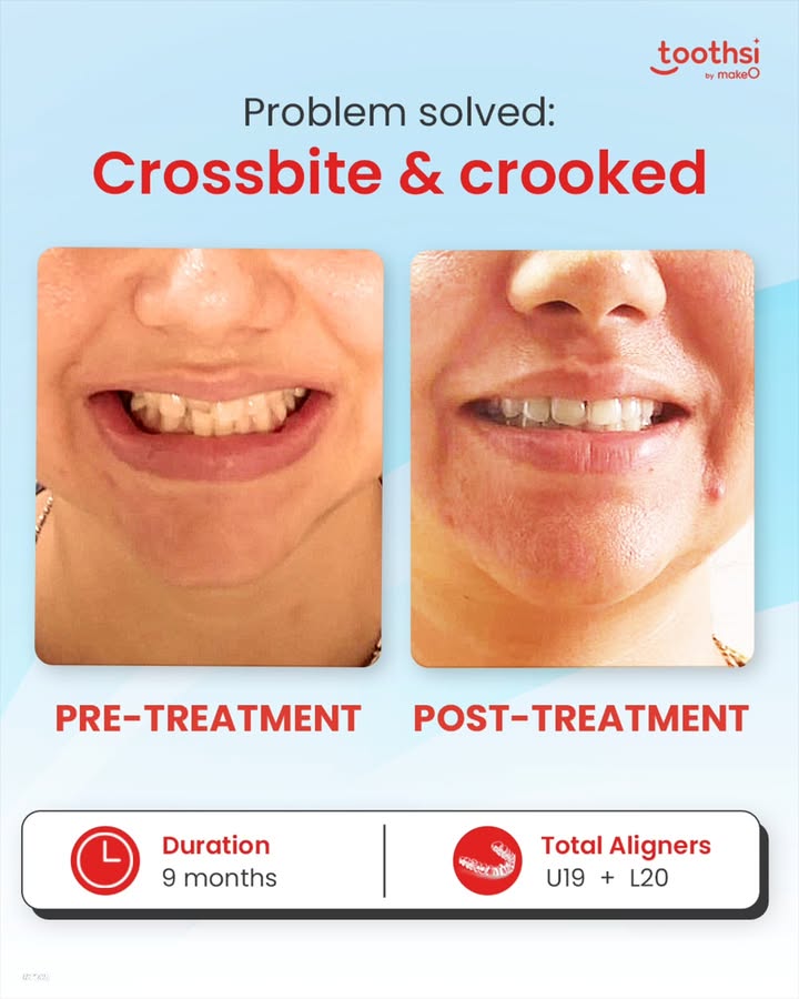 Priyanka always hid her smile because of her crooked teeth and crossbite. Eating was tricky, and smiling Even trickier. But everything changed when she chose toothsi invisible aligners Priyanka always hid her smile because of her crooked teeth and crossbite. Eating was tricky, and smiling Even trickier