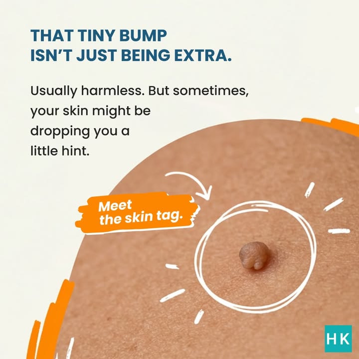 That little skin tag Dont panic. But dont ignore the bigger picture either