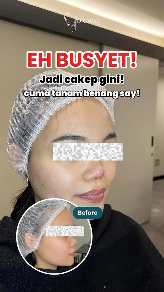 Mau hidung terlihat lebih tinggi dan tegas tanpa operasi Tanam Benang Hidung bisa membantu membentuk kontur hidung yang le...